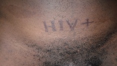 Tattooed HIV Positive person